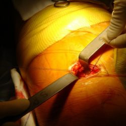 Chirurgie mini invasive de la hanche - Bordeaux