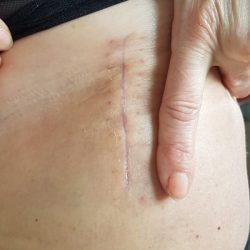 Chirurgie mini invasive de la hanche - Bordeaux